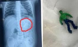 Toddler Swallows Hulk Toy; Doctors Remove Toy Via Endoscopy